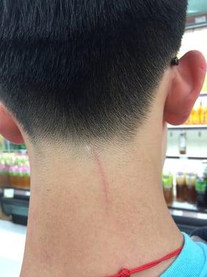 Wound on my boyfirend's neck