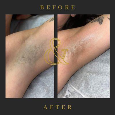 Before & After of an Underarm Wax