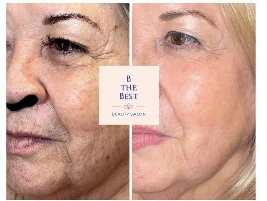 Fibroblast plasma skin tightening on the whole face