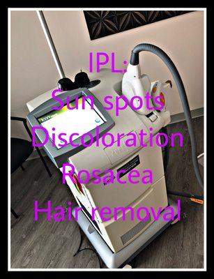 IPL - sunspot and discoloration removal, rosacea treatment