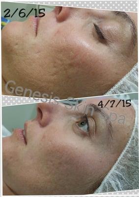 Micropen ( Collagen Induction Therapy )