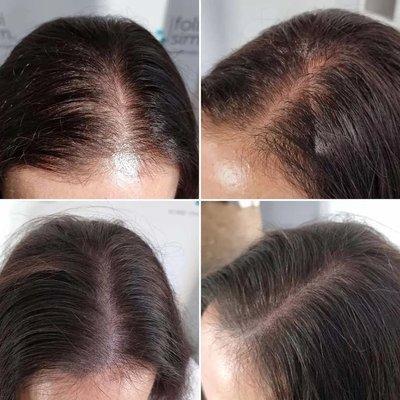 Female Scalp Micropigmentation