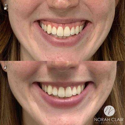 Gummy smile treatment with Botox/Dysport!