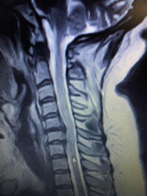 neck pain from the disc seen on this mri notice the bulging discs and the spinal cord. there is no longer the normal expected curve either