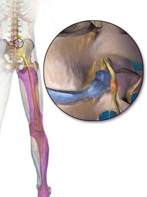 An example of how sciatica develops