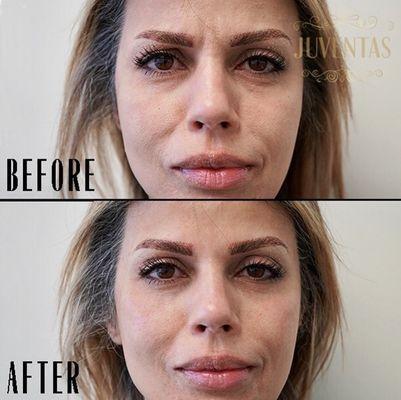 Before and After of Daxxify, Only Daxxify® uses a small peptide instead of a larger animal-based protein that is in Botox® and Dyport®. The