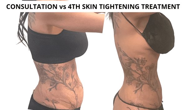 Fourth Liquid Tightening treatment for petite mom to change the landscape of her body.  Look at how the shape of her tattoo changed.