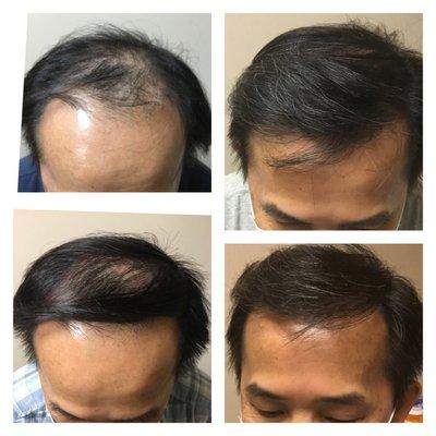 2500 grafts.  12 months after