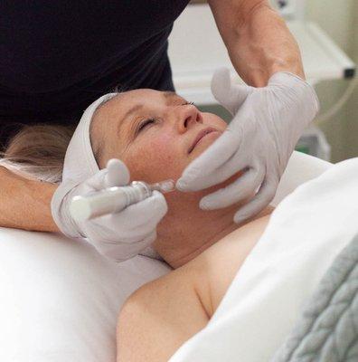 microneedling