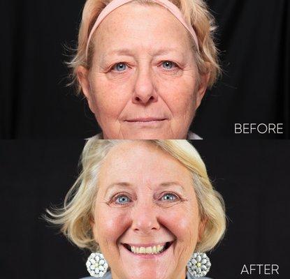 Blepharoplasty