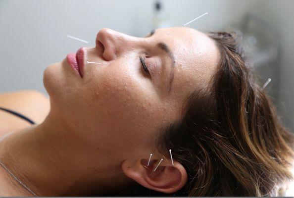 Facial and Ear acupuncture for allergies, sinus and stress.