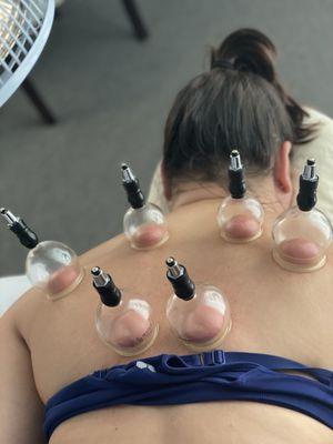 Cupping for tight/sore back