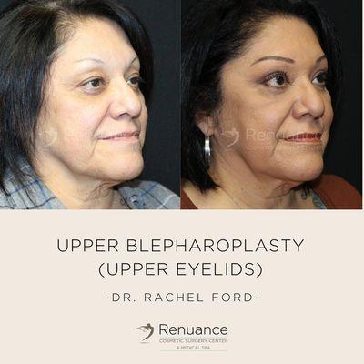 Before and after upper eyelid lift