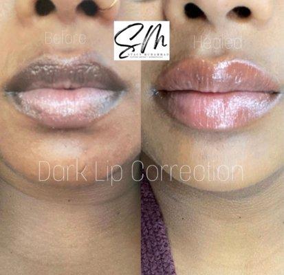 Dark lip correction using tattoo.  She is amazing