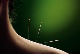 acupuncture!