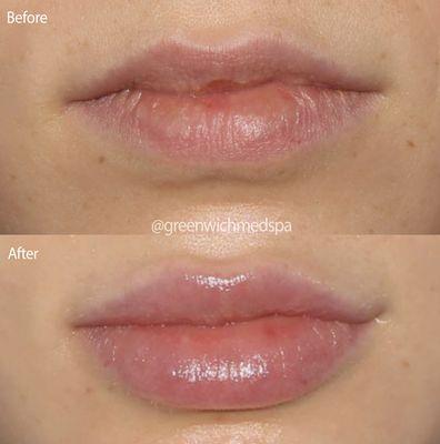 Lip filler Before & After