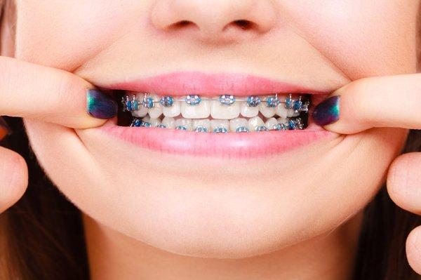 Leesburg expert in braces for all ages.