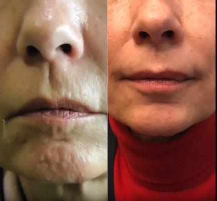 Lip and Chin Rejuvenation