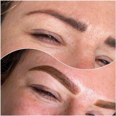 Brow correction