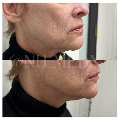 Before & After of Chin Filler