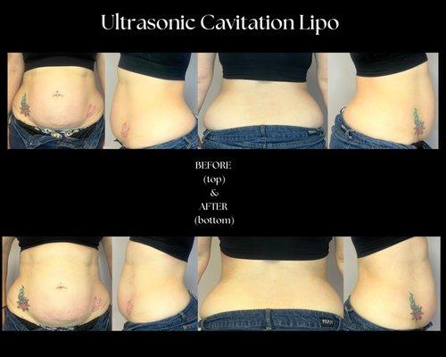 Ultrasonic Cavitation Bodysculpting- Before & Afters on abdomen.