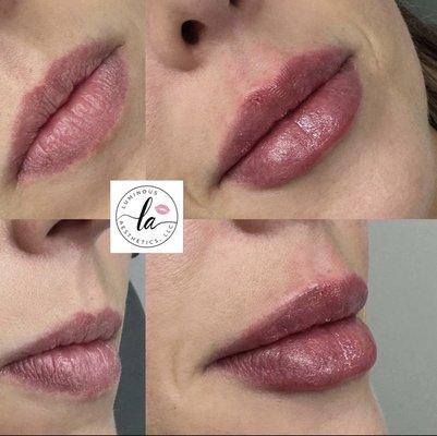 Lip filler