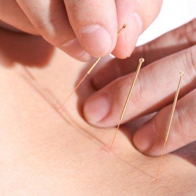 Physician Acupuncture