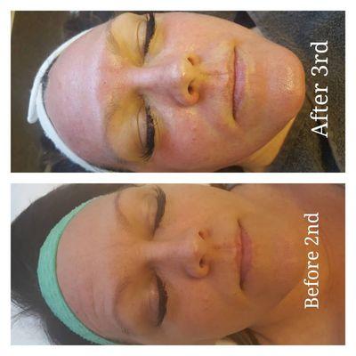 Microneedling before and after!!