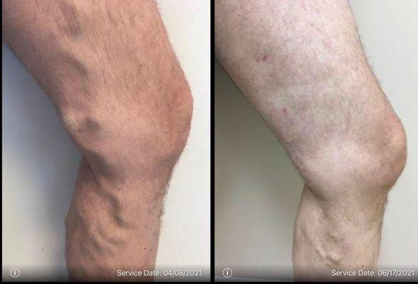 Varicose Veins
Before and After Treatment