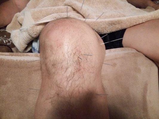 Acupuncture Treatment for Anterior Ligament Tear. He could avoid knee replacement surgery.