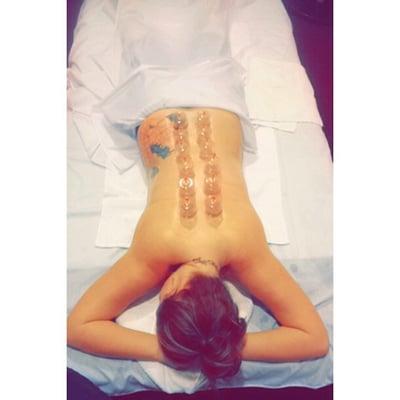 Cupping Therapy