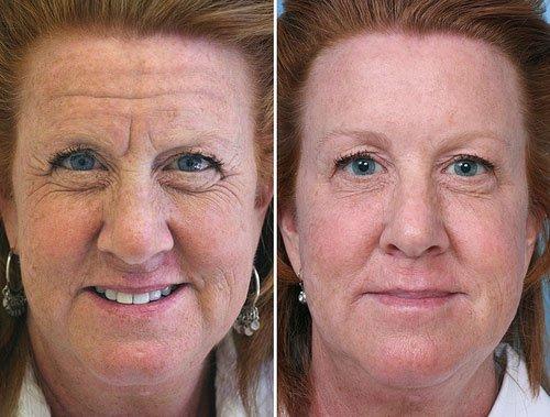 Botox Before and After