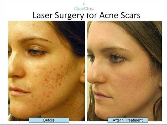 Laser Surgery for Acne Scars