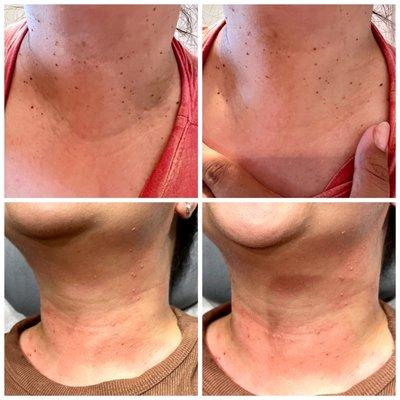 Before and right after skin tag removal