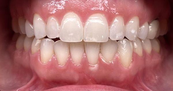 Love the teeth whitening on this one, such great results.  We use poppy teeth whitening as our rep.