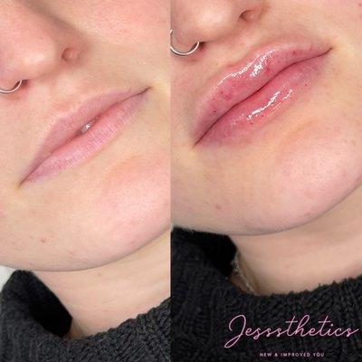 After 2ml focused most of the filler on this babes top lip