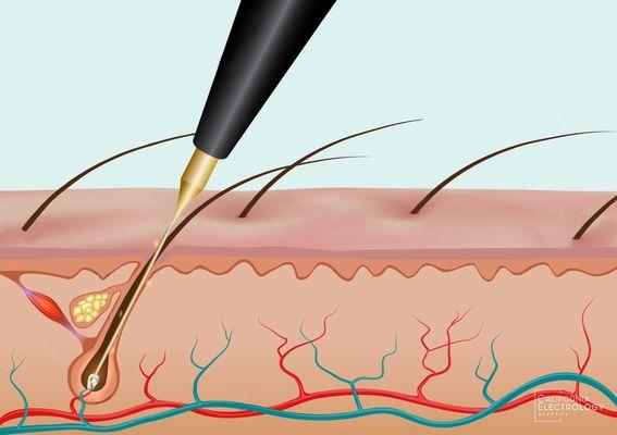 Learn the ins and outs of a proper insertion