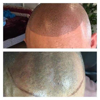 Scalp MicroPigmentation for Men. Treatment for baldness or thinning hair.