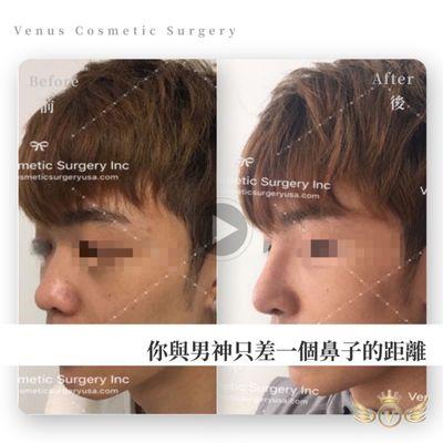 Rhinoplasty