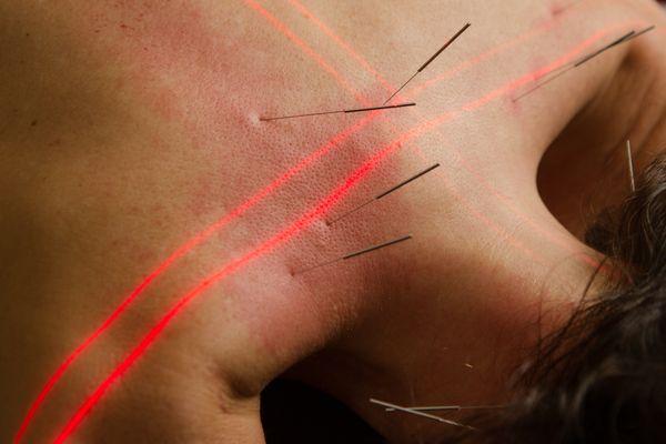 Erchonia cold laser, used with acupuncture