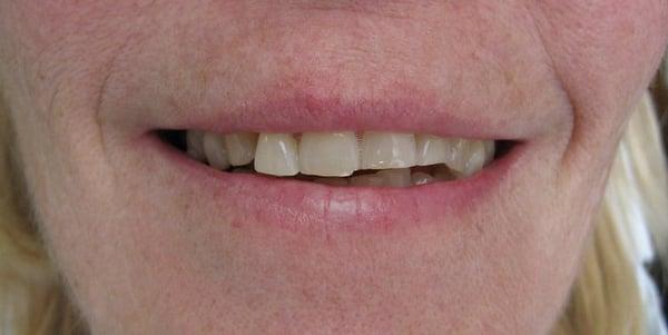 This patient wanted to improve her smile.