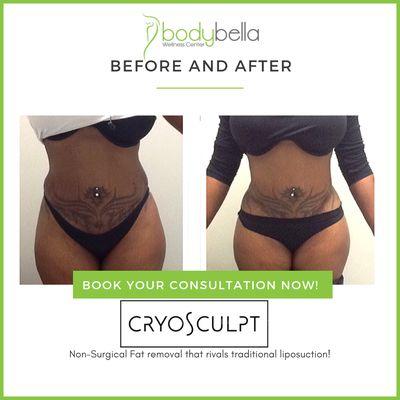 CryoSculpt 45 day before and after of only love handles.