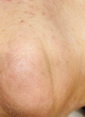 Woman hair removal chin #2