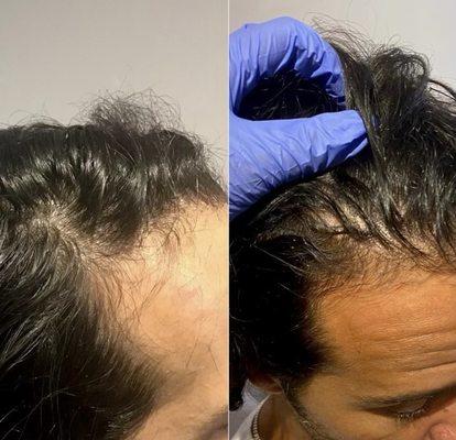 Our client has had multiple PRP treatments for his thinning hair, resulting in thicker hair and regrowth of hair at his hairline