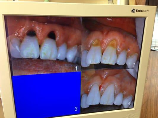 From left (top) to right (top, bottom): Decay, Removed Decay, Bonded Restored Teeth