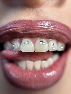 Tooth gems