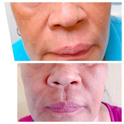 Before & After Dermal Filler for Nasolabial Folds & Oral Commissure