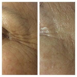 After one session of microcurrent crows feet are more firm and softer on a 59 year old female.