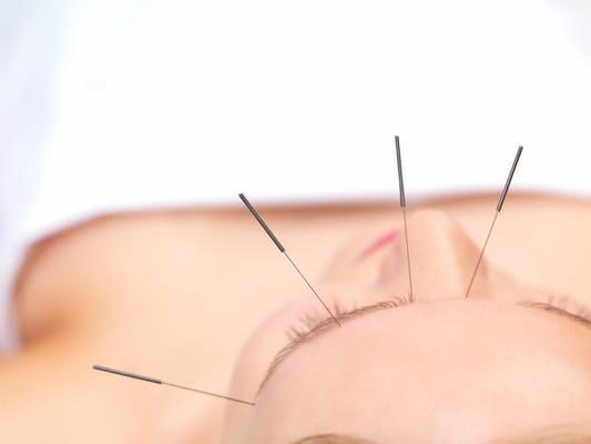 Cosmetic Acupuncture