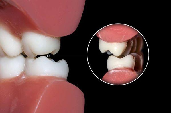 Why Teeth Grinding Should Never Be Ignored